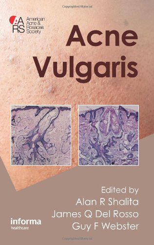 Acne Vulgaris - Original PDF